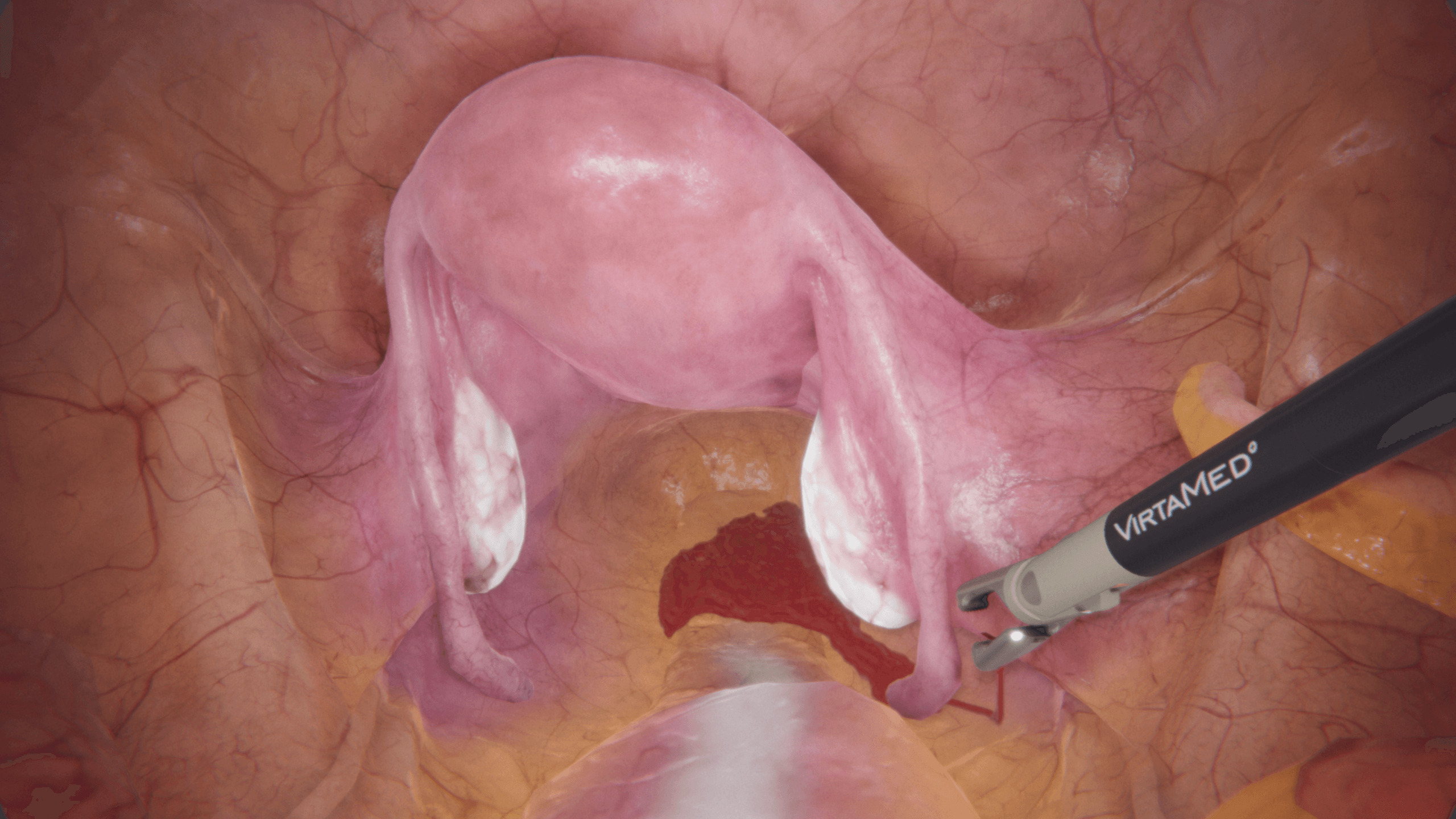 Ovarian artery bleeding on the right