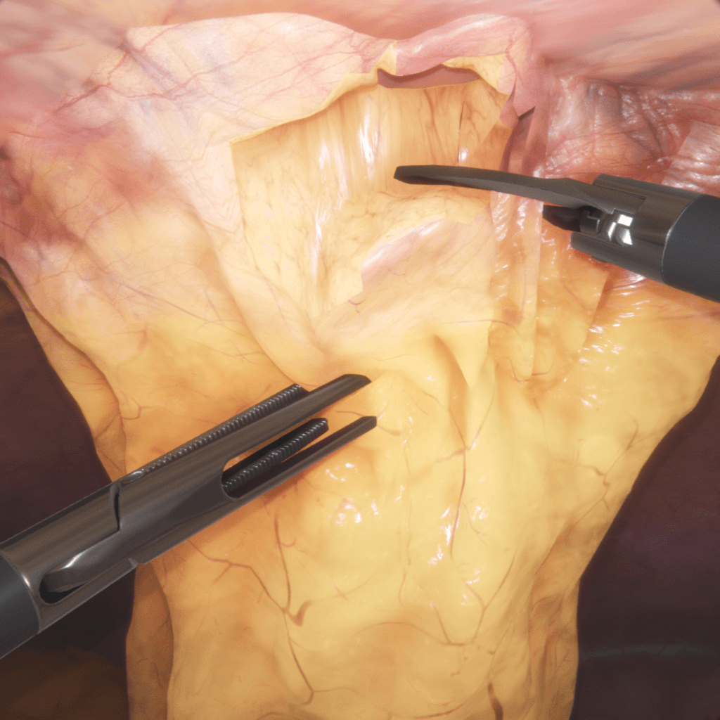 Hernia Incision for medical training